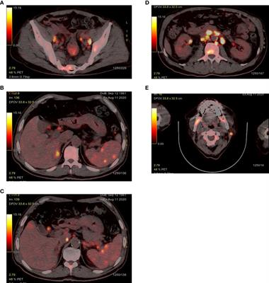 A case report of synchronous triple primary malignancies: Diffuse large B-cell lymphoma, rectal adenocarcinoma and hepatocellular carcinoma